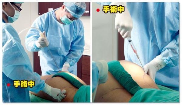 {網上賭場}(局部抽脂手术价格一览表最新) {網上賭場}(局部抽脂手术价格一览表最新)